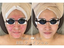 ギンレイ(GINREI)/ 【Before → After】