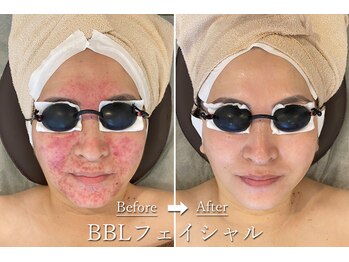 ギンレイ(GINREI)/ 【Before → After】