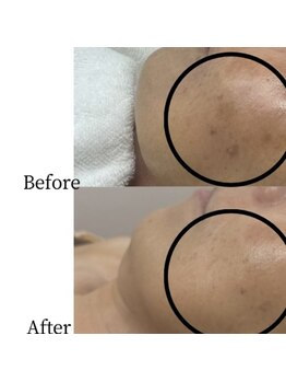 アピール(Appeal)/シミの改善&予防におすすめ☆