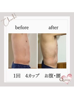 クイーン(QUEEN)/脂肪冷却 4カップ