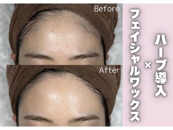 モンエピレ(MON epiler)/つるんとなめらかなツヤ肌へ☆