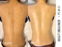 ピュアノア 三木店/背中ピーリング　三木|小野|西脇