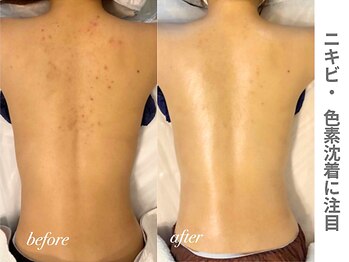 ピュアノア 三木店/背中ピーリング　三木|小野|西脇