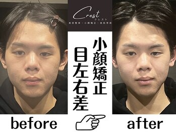 クレスト(CREST)/ビフォーアフター【小顔名古屋】