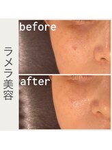 お気軽ビューティエーヴィヒ(Ewig)/本気の肌質改善★ラメラ美容