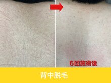 ミスターアンクール 鹿児島(Mr.uncoeur)/背中脱毛6回後