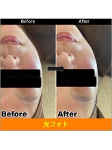 ベルージュ(Bellege)/光フェイシャル