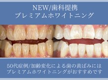 ホワイトニングカフェ 平塚店(WhiteningCafe)/◎歯のホワイトニング施術写真◎