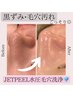 【いちご鼻撃退！！】JETPEEL毛穴洗浄＋ヒアルロン酸美容液導入＋肌別パック