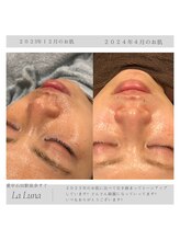 ラルーナ(LA LUNA)/ハーブピーリングのお客様