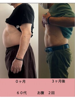 まつもと美容整体 整骨院/脂肪冷却効果!