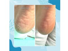巻き爪補正店 秋葉原店/【踵の角質】