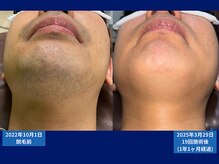 父さん専用ヒゲ脱毛の店/脱毛比較写真　＃メンズ脱毛