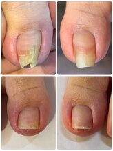 ネイルカフェ ナナ(nailcafe'nana)/巻き爪ケア