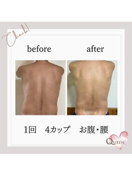 クイーン(QUEEN)/脂肪冷却 4カップ