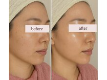 ピュルテ/水光ピールで角質ケア！