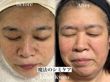 リベルキョウト 京都駅前店(Liber Kyoto)/魔法のシミケア
