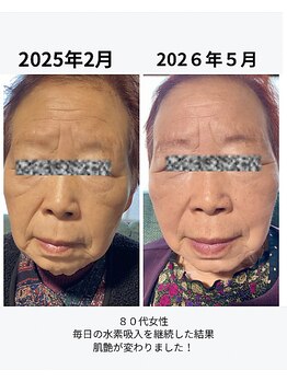 ヨサパーク すずのね(YOSA PARK)/水素吸入でエイジングケア