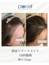 ユミト(Umit)/プロセルスカルプ