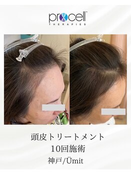 ユミト(Umit)/プロセルスカルプ