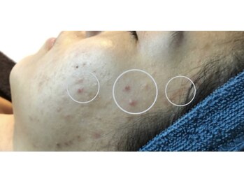 ベルーチェ(Beluce)/マスク生活で荒れてしまった肌に