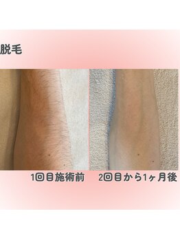 クレアナ ザ ビューティー(KULEANA the beauty)/光脱毛