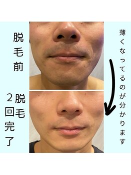 ワイズサロン(Y's salon)/ヒゲ脱毛2回終了から2週間後