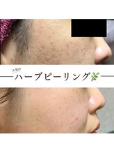 ワン(ONE)/ハーブピーリング