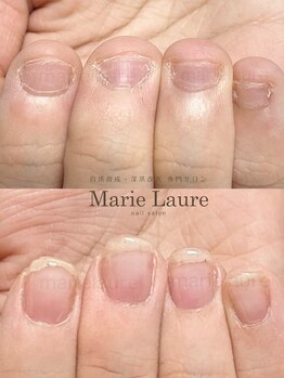 マリーロール 梅田店(Marie Laure)/自爪育成/深爪矯正/ネイルケア