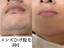男性の方のひげ脱毛(1回/5500円)、、お肌のお手入れも大好評