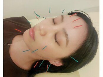 はり灸心音/美容鍼比較-ライト☆