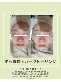 ソワナ(soina)/【神楽坂駅/フェイシャル/毛穴】