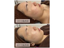 リノン(LINON)/韓国ピーリング 施術回数4回 