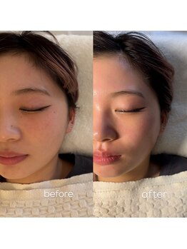 ビオトーン バイ ツリー(biotone by TREE)/フルフェイシャル/Wax脱毛