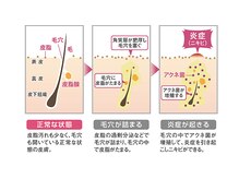 トータルビューティーサロン ヴィヴィエ(ViVier)/ララピール×ニキビ