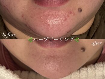 まつげエクステ専門店 クレイン(CRANE)/ハーブピーリング