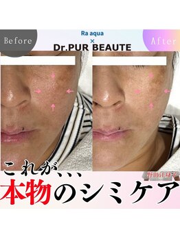 エステティックサロン ラ アクア(ra aqua)/肌育コースの威力本当にすごい!