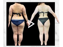 エステティック エイチアンドビー 大和店(H&B)/ビフォーアフター