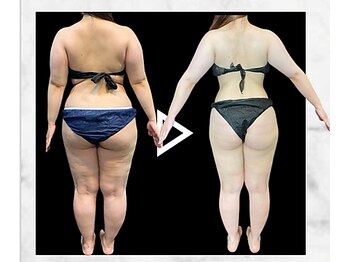 エステティック エイチアンドビー 大和店(H&B)/ビフォーアフター