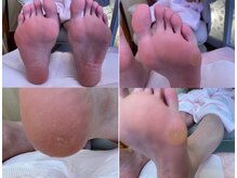 ビサンテ サロン/角質ケア＆角質育成ケア-1