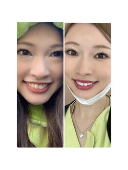 ホワイトニングスタイル 柏店/歯が白いと顔の印象が変わる！