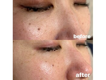 ヴィエルージュ(Vierouge)/ハーブピーリング×ハイドラ