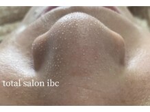 トータルサロンアイビーシー(トータルサロンIBC)/大人気！ 毛穴洗浄