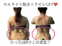 痩身革命 大宮店/施術写真（痩身）