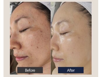 エスビーエス オキナワ(SBS OKINAWA)/第5世代ダクトピールモニター様