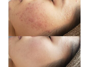 プシュケ(Psyche)/お客様の肌変化