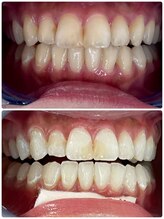 エクシアホワイトニング 札幌中島公園店/Before After［ホワイトニング］