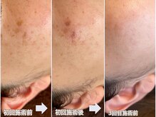 ティーツリー 名古屋 桜山(Tea Tree)/痛み最小シミケア