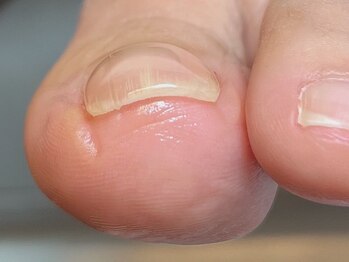 フロム(...froM)の写真/自爪から健康的で美しい指先へ…乾燥・二枚爪、巻き爪等のお悩みに寄り添ってサポートしていきます。