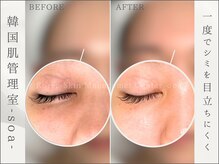 韓国肌管理室 ソア(soa)/【1度でシミを目立ちにくく】